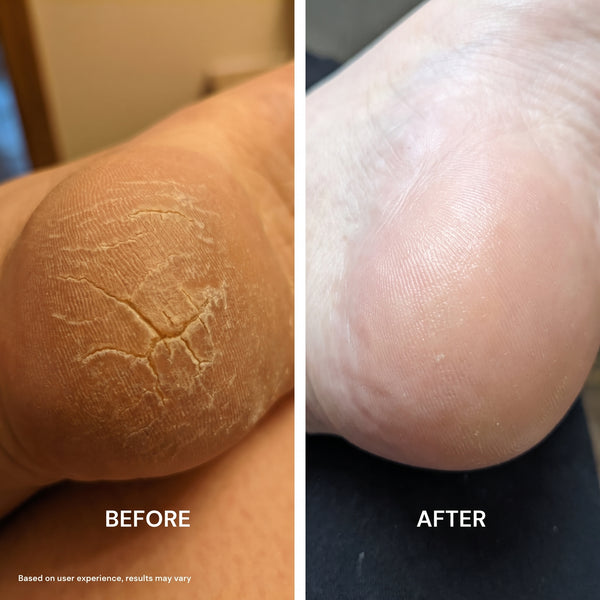 Walking pain-free
