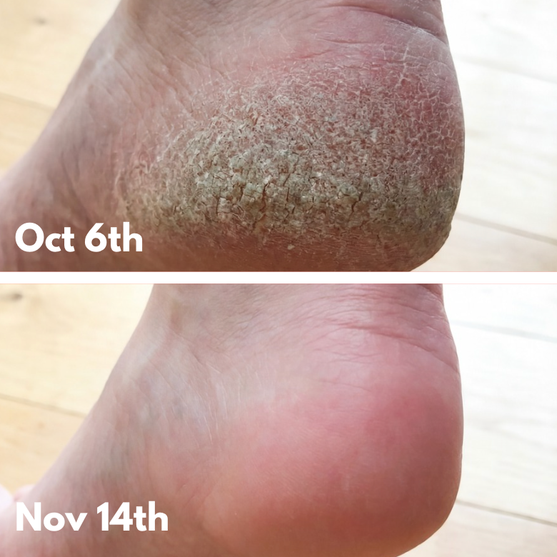 3. It Doesn't Just Fix Cracked Heels — It Changes The Way You Walk Through Life.