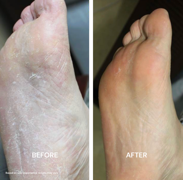 Rough Dry Skin