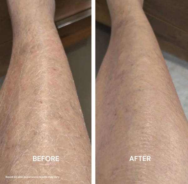 Dry Leg Skin