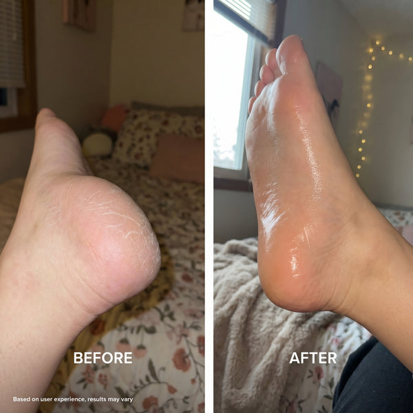 No More Callus Build-Up