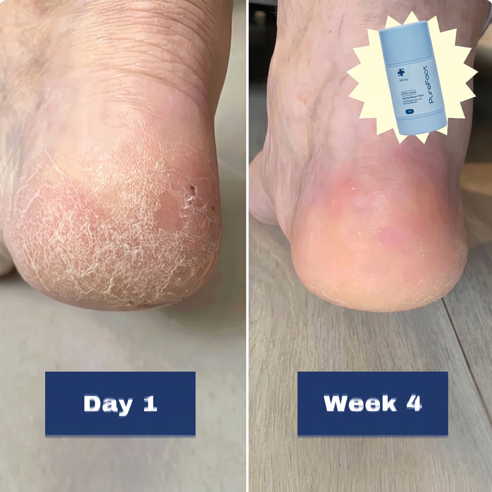 1. Contains 60% urea - So it targets the actual cause of cracked feet