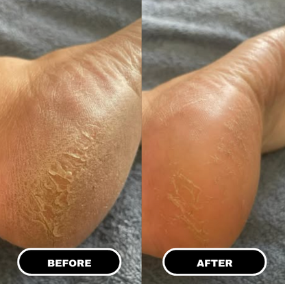 PureFoot Relief Stick