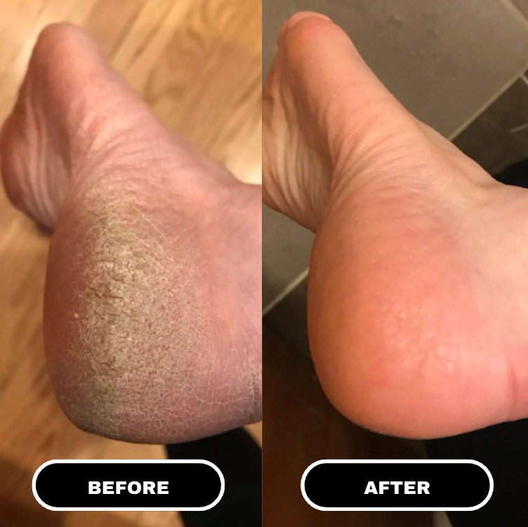 PureFoot Relief Stick