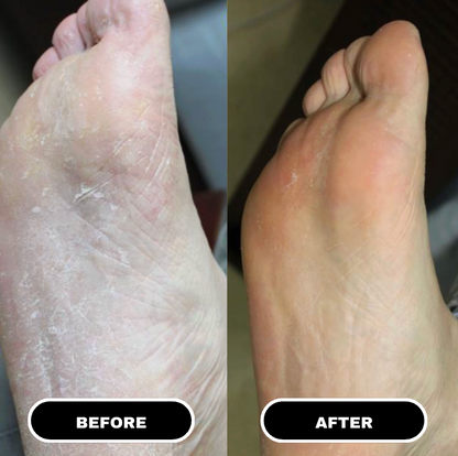 PureFoot Relief Stick