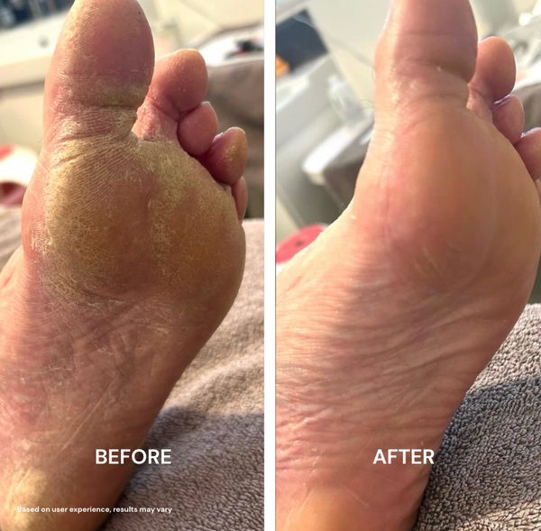 Painful Calluses